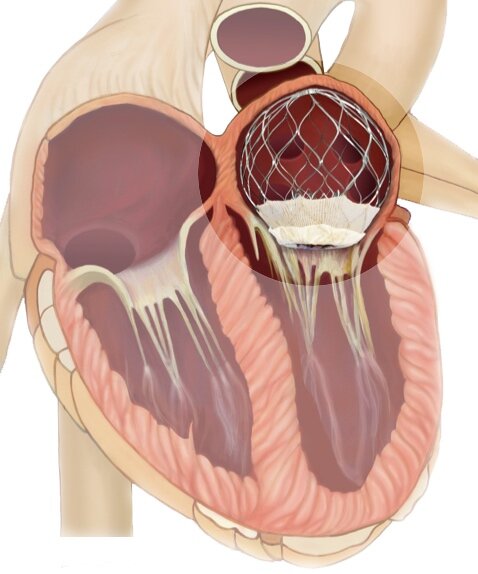Eρευνητικό πρόγραμμα διαδερμικής αντικατάστασης μιτροειδούς βαλβίδας στο Ιατρικό Διαβαλκανικό