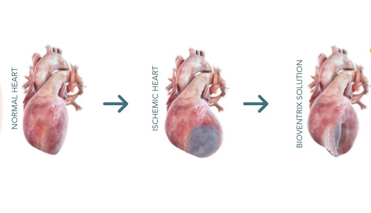 Πρωτοποριακή διαδερμική επέμβαση στο Ιατρικό Διαβαλκανικό για την ανεπάρκεια καρδιάς λόγω εμφράγματος