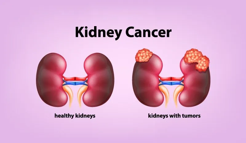 Νεότερα δεδομένα από το ASCO GU στον καρκίνο του νεφρού