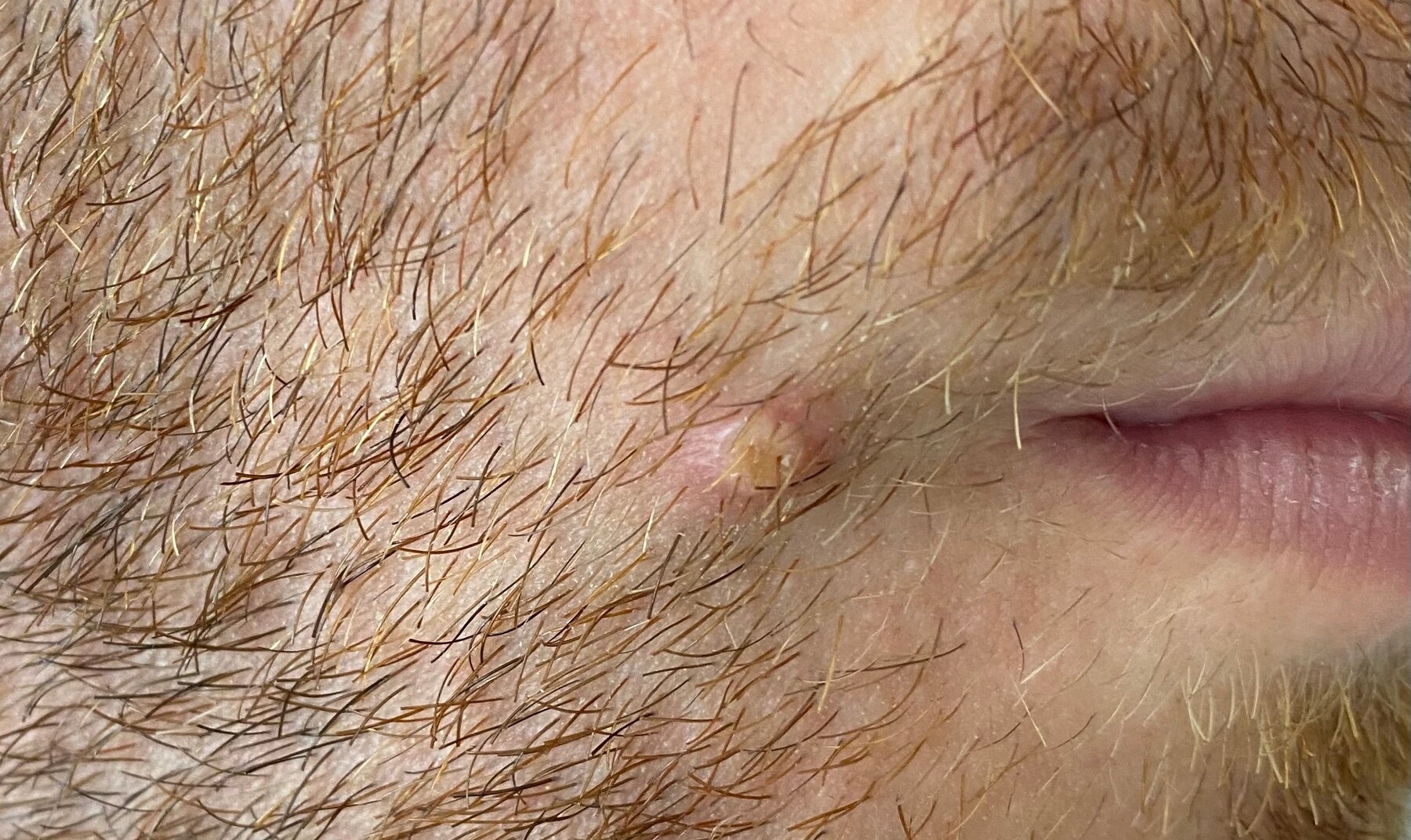 Στη Σουηδία το πρώτο ευρωπαϊκό κρούσμα Ευλογιάς των Πιθήκων